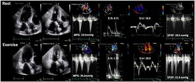 Stress echocardiography in valvular heart disease